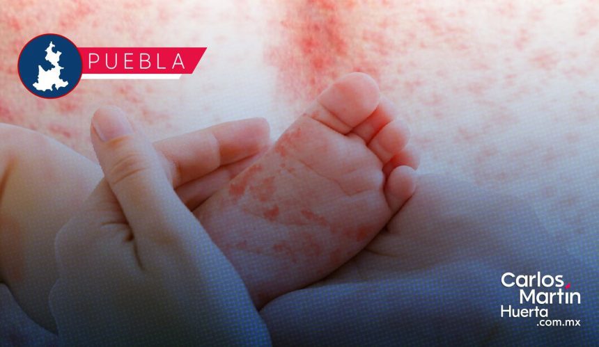 Sarampión llega a 17 municipios de Puebla; suman 196 casos positivos