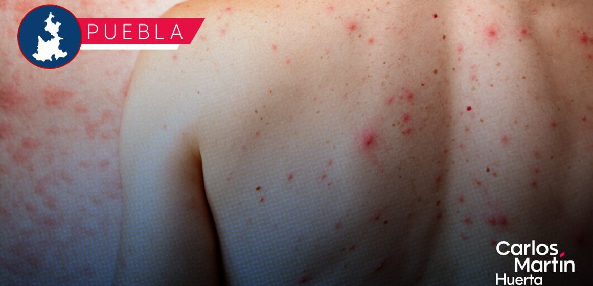 Brote de sarampión supera los 200 casos confirmados