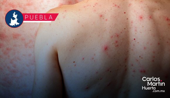 Brote de sarampión supera los 200 casos confirmados