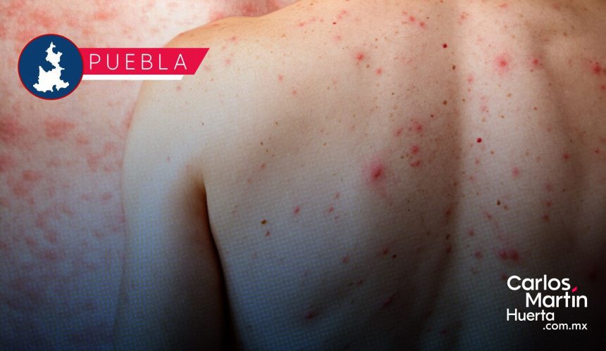 PHOTO-2026-03-27-10-38-14 Brote de sarampión supera los 200 casos confirmados