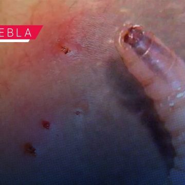 Puebla reporta cinco casos confirmados de gusano barrenador en humanos