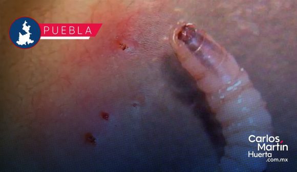 Puebla reporta cinco casos confirmados de gusano barrenador en humanos Puebla reporta cinco casos confirmados de gusano barrenador en humanos