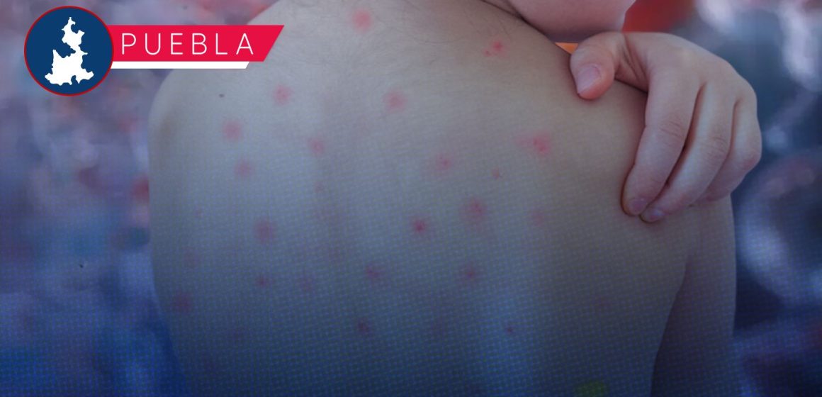 Sarampión Puebla Puebla a un paso de los 200 casos de sarampión: Suman 198 contagios y 452 probables