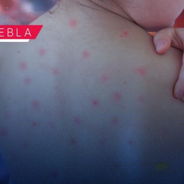 Puebla a un paso de los 200 casos de sarampión: Suman 198 contagios y 452 probables