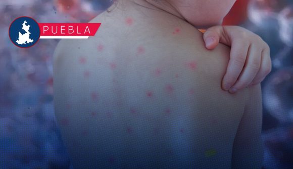 Puebla a un paso de los 200 casos de sarampión: Suman 198 contagios y 452 probables