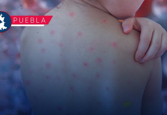 Puebla a un paso de los 200 casos de sarampión: Suman 198 contagios y 452 probables