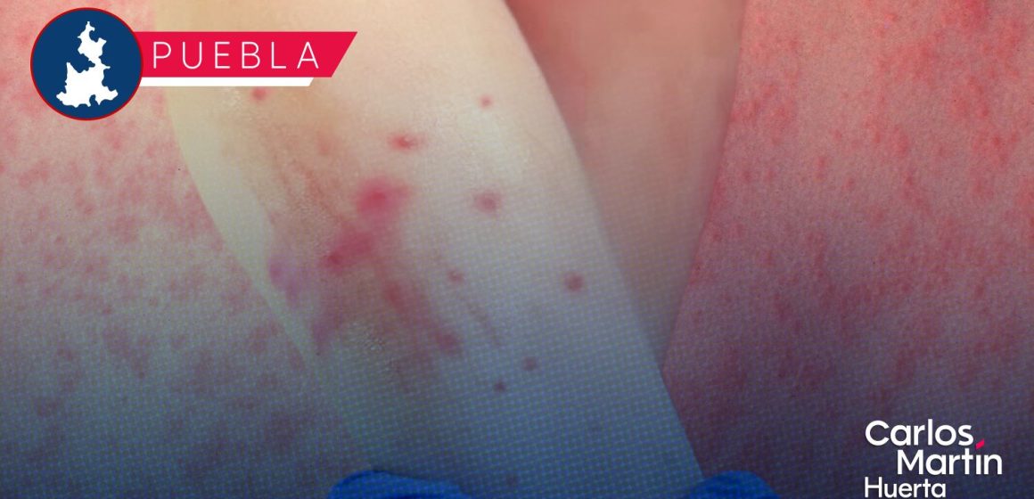 Sarampión en Puebla: Se estabilizan contagios en 196, pero aumentan los casos sospechosos