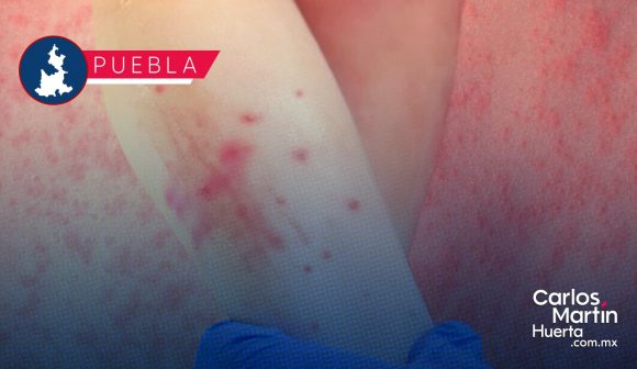 Sarampión en Puebla: Se estabilizan contagios en 196, pero aumentan los casos sospechosos