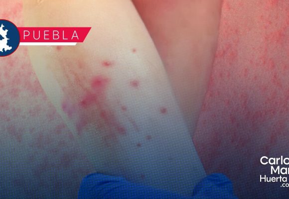 Sarampión en Puebla: Se estabilizan contagios en 196, pero aumentan los casos sospechosos