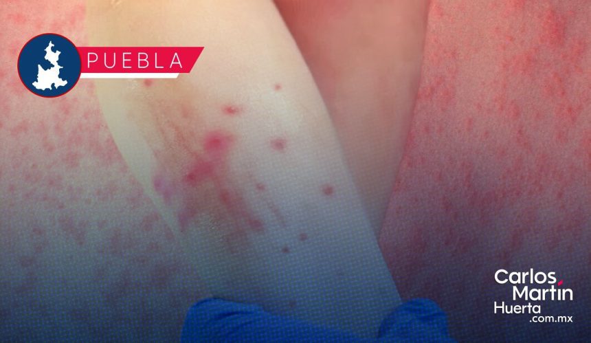 Sarampión en Puebla: Se estabilizan contagios en 196, pero aumentan los casos sospechosos