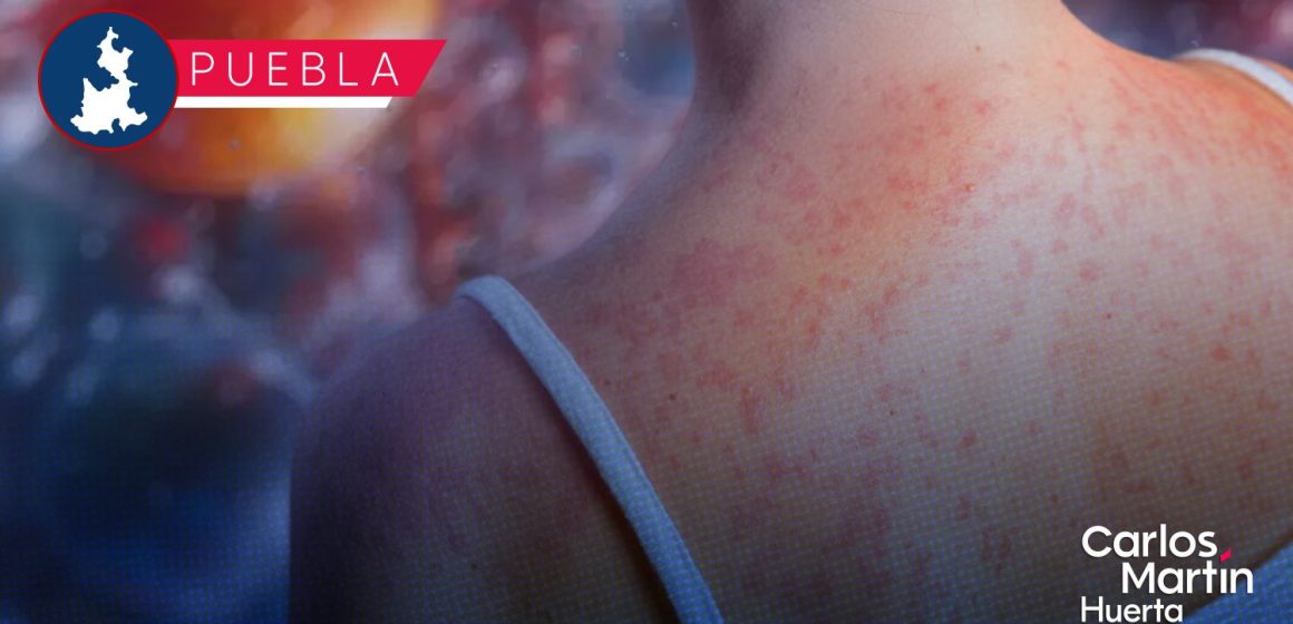 ¡Regresa el sarampión! Puebla reporta 4 nuevos contagios y suma 145 casos