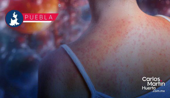 ¡Regresa el sarampión! Puebla reporta 4 nuevos contagios y suma 145 casos