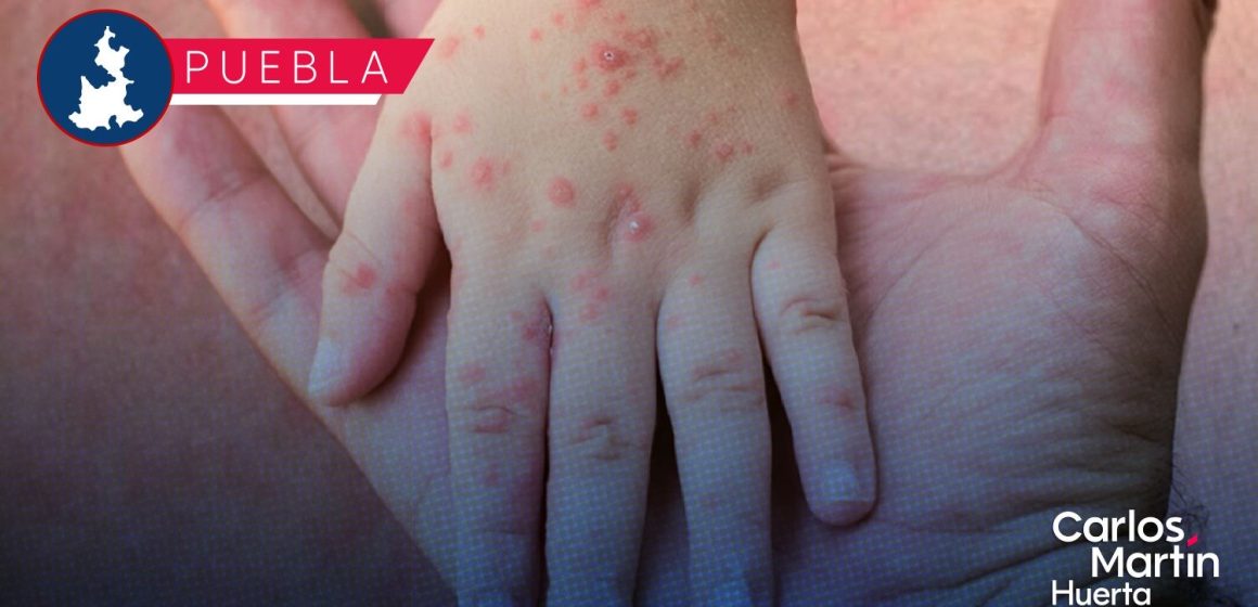 Se rompe la tregua: Puebla registra nuevo contagio de sarampión y ya suma 146 casos 