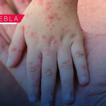 Se rompe la tregua: Puebla registra nuevo contagio de sarampión y ya suma 146 casos 