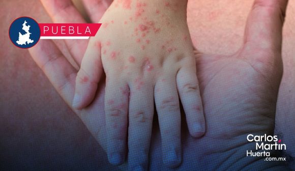 bc5993ff-88f0-4df1-b255-1ab7c67fd6ee Se rompe la tregua: Puebla registra nuevo contagio de sarampión y ya suma 146 casos