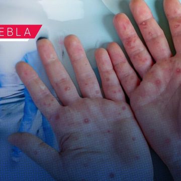 Alerta en Puebla: Se disparan contagios de sarampión; reportan 6 nuevos casos en 24 horas 