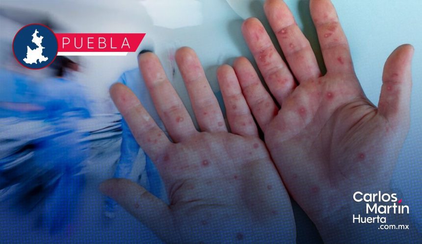 Alerta en Puebla: Se disparan contagios de sarampión; reportan 6 nuevos casos en 24 horas 