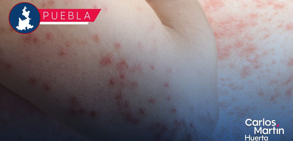 Suman 217 casos de sarampión en 21 municipios; 225 casos descartados