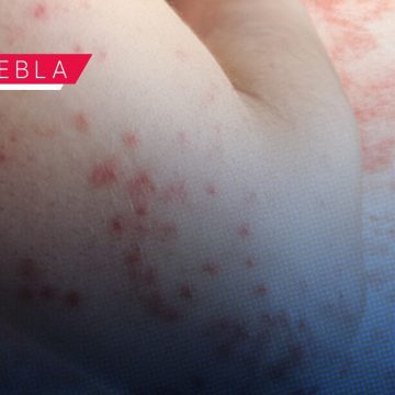 Suman 217 casos de sarampión en 21 municipios; 225 casos descartados