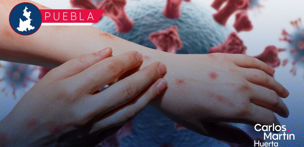 Sarampión: Puebla registra 205 casos confirmados en 17 municipios