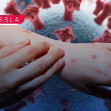 Sarampión- Puebla registra 205 casos confirmados en 17 municipios Sarampión: Puebla registra 205 casos confirmados en 17 municipios