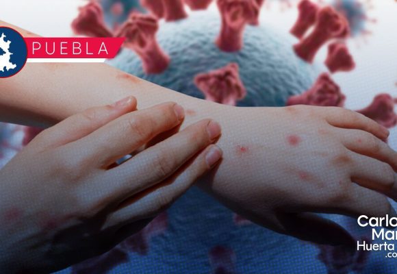 Sarampión: Puebla registra 205 casos confirmados en 17 municipios