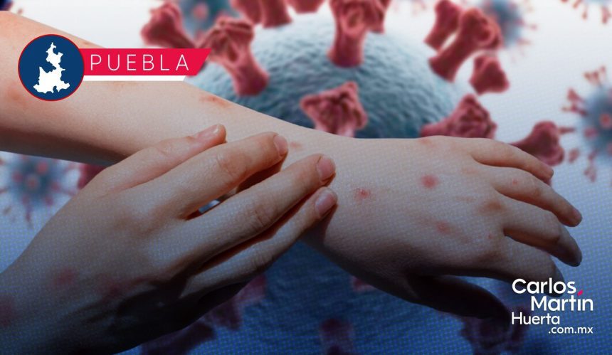 Sarampión: Puebla registra 205 casos confirmados en 17 municipios