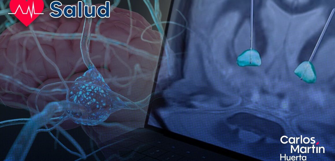 Síndrome de Tourette: La estimulación cerebral profunda podría frenar los tics