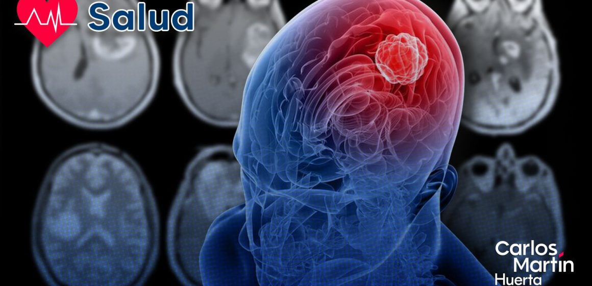 Fármaco en desarrollo para el lupus muestra eficacia para frenar el glioblastoma