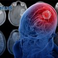 Fármaco en desarrollo para el lupus muestra eficacia para frenar el glioblastoma
