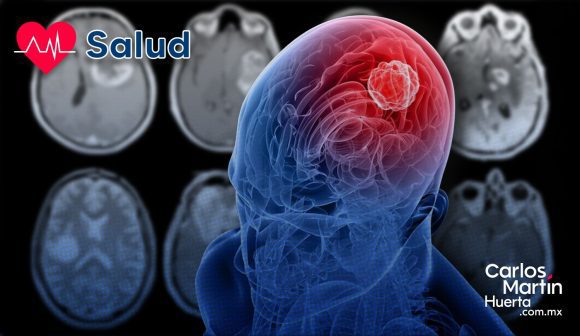 Fármaco en desarrollo para el lupus muestra eficacia para frenar el glioblastoma