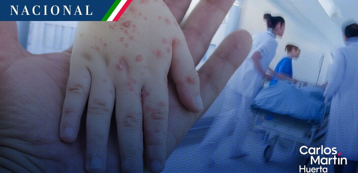 Contagios de sarampión suman 18 mil 157 casos y 41 muertes en México