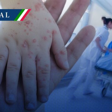 Contagios de sarampión suman 18 mil 157 casos y 41 muertes en México
