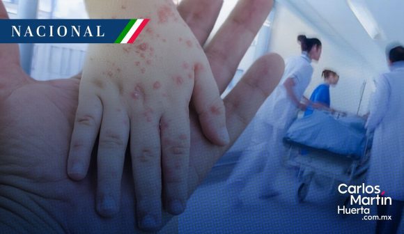 Contagios de sarampión suman 18 mil 157 casos y 41 muertes en México